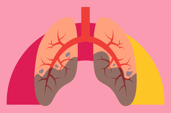 Penyakit Menular Dari TBC Atau Tuberkulosis Dan Bakteri