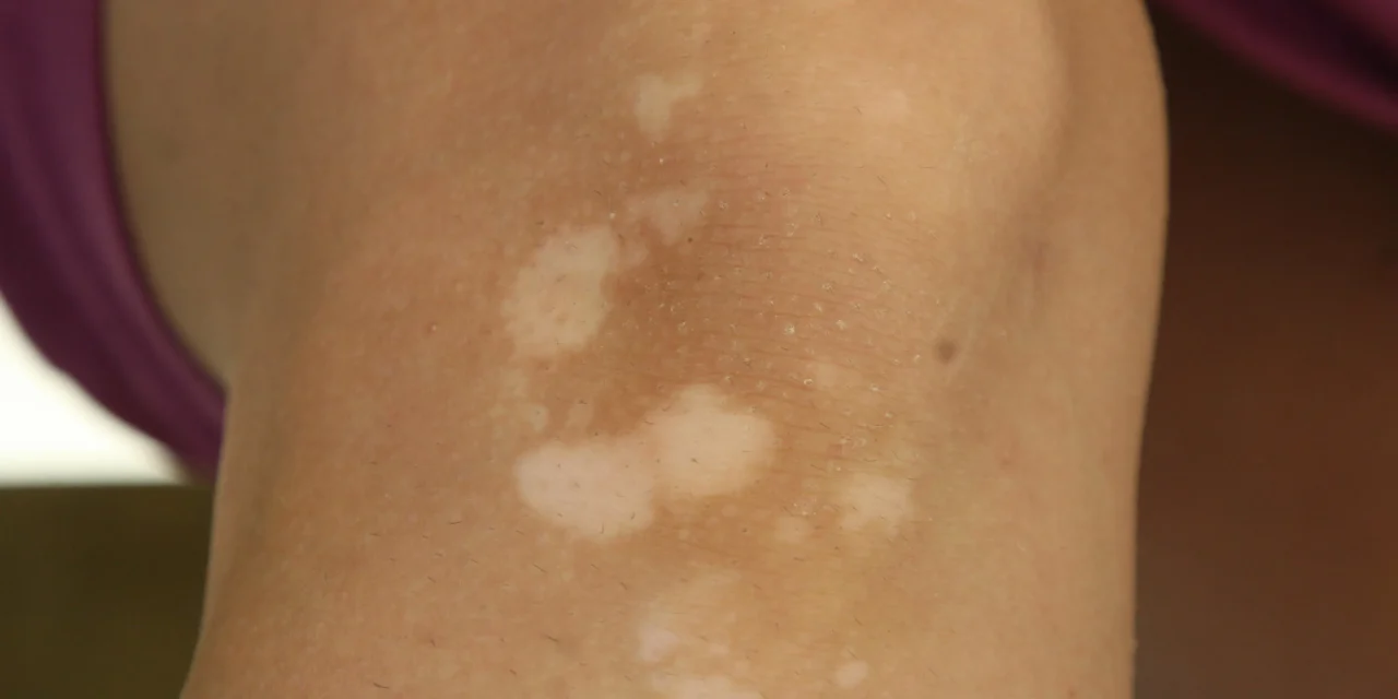 Kondisi Panuan Pada Beberapa Area Kulit Di Tubuh