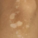 Kondisi Panuan Pada Beberapa Area Kulit Di Tubuh