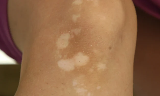 Kondisi Panuan Pada Beberapa Area Kulit Di Tubuh