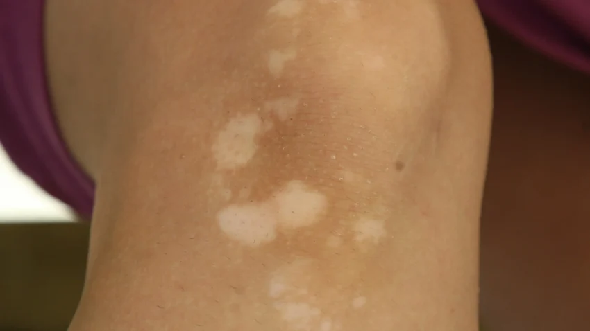 Kondisi Panuan Pada Beberapa Area Kulit Di Tubuh