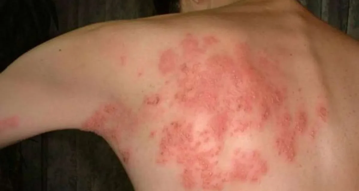 Penyakit Infeksi Virus Herpes Pada Sebuah Kulit