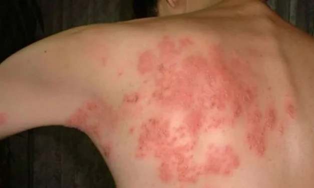 Penyakit Infeksi Virus Herpes Pada Sebuah Kulit