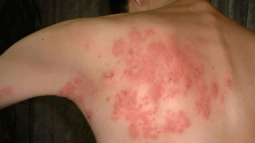 Penyakit Infeksi Virus Herpes Pada Sebuah Kulit