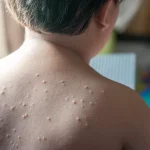 Keadaan Sakit Kulit Salah Satunya Cacar Air