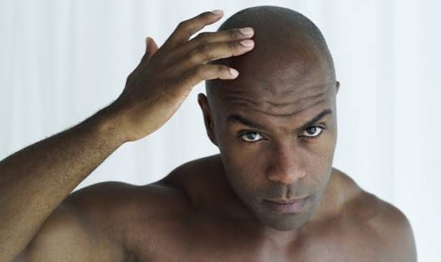 Kebotakan Pada Rambut Seseorang Yang Tua
