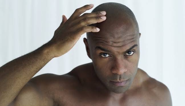 Kebotakan Pada Rambut Seseorang Yang Tua